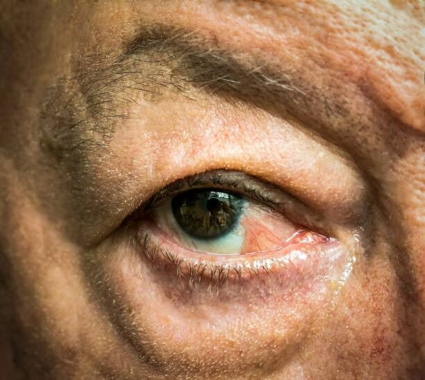 Pterygium